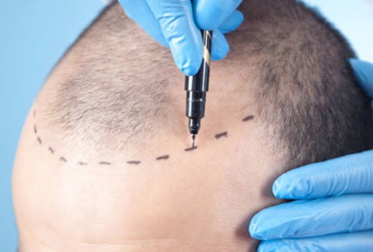 Unlock Your Confidence: How to Choose the Right Hair Transplant Doctor in Durgapur