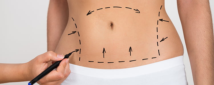 Abdominoplasty